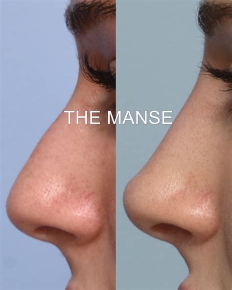 Nose Filler: Non-surgical rhinoplasty at our Expert Sydney Clinic