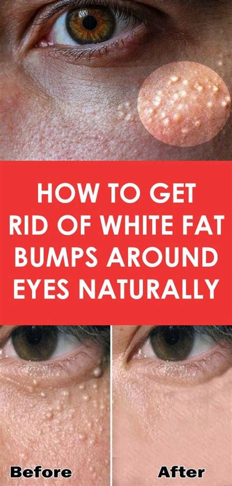 How To Get Rid of White Fat Bumps Around Eyes Naturally | mooseteaparty