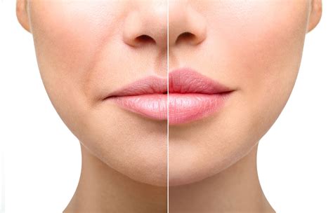 What Are The Different Types of Lip Augmentation? | South Florida ...