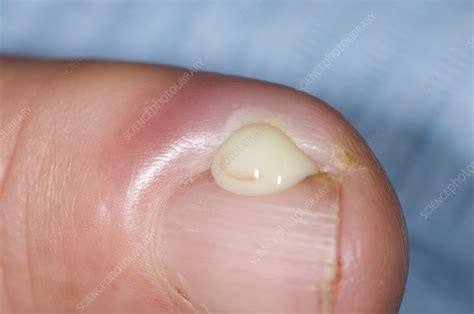 Paronychia infection of the finger - Stock Image - C009/0030 - Science ...