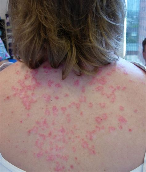 Lupus Skin Rash On Arms