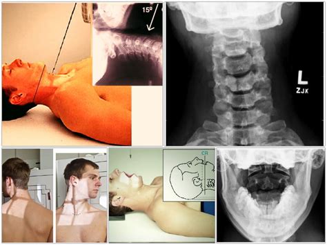 Cervical Spine or Neck X-ray Radiography - RadTechOnDuty