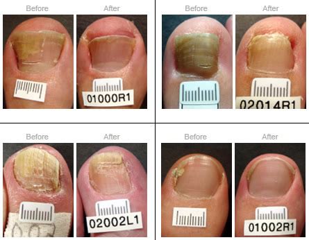 Laser Treatment for Fungal Toenails - Associated Foot & Ankle Specialists