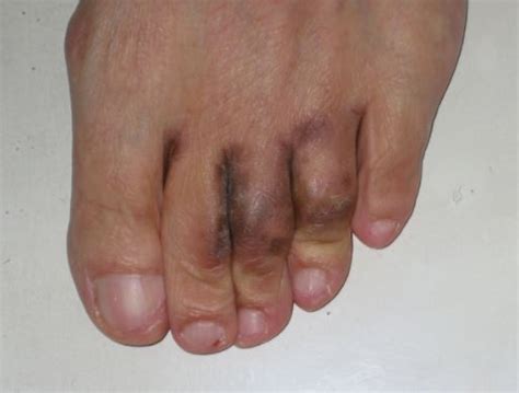 Stubbed Toe, Meaning, Hurts months later, Turned Black, Pictures ...