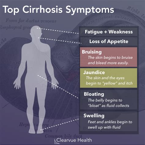 3 Charts | What is NASH Fibrosis? | A Visual Guide