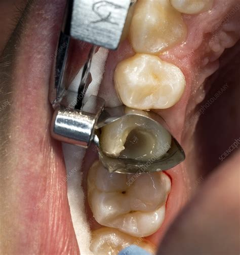 Dental Cavity Filling