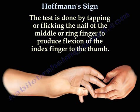 Image result for hoffman's reflex | Medical, Signs, Medical school