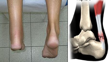 Achilles Tendon Rupture - Causes, Symptoms, Treatments, and Diagnosis - Body Pain Tips