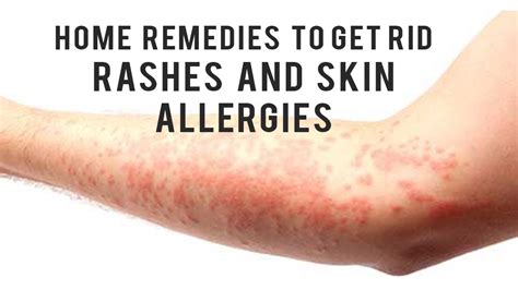 How To Get Rid Of A Skin Rashes That Itch Youtube - vrogue.co