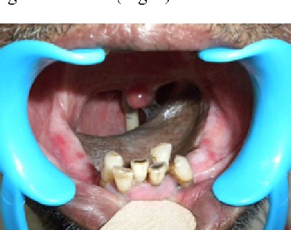 Figure 1 from REHABILITATION OF A TOTAL GLOSSECTOMY PATIENT WITH TONGUE PROSTHESIS AND PALATAL ...