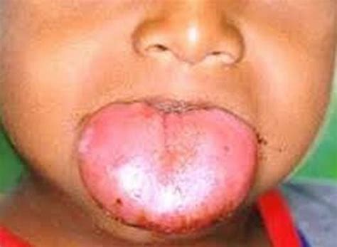 Macroglossia causes, signs, symptoms, diagnosis & macroglossia treatment