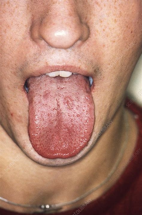 Syphilis in the mouth - Stock Image - C022/2807 - Science Photo Library