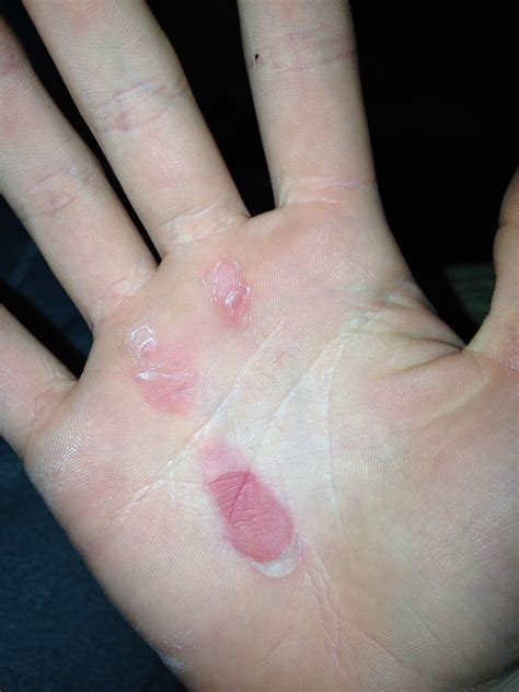 Pin on Gymnastics - Rips/Pain