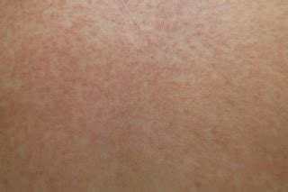 Morbilliform rash Pictures, Definition, Symptoms, Causes, Treatment - Health Care Tips and ...