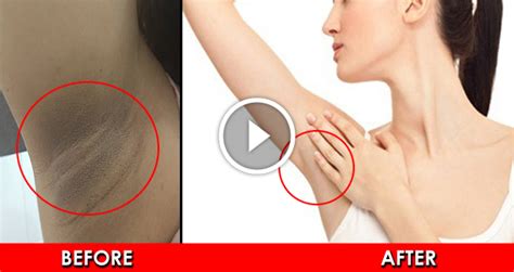 Best Home Remedies For Dark Underarms - Style Hunt World