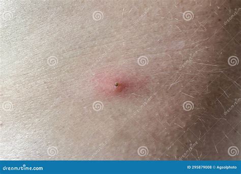 Close-up of a Tick Embedded in a Personskin at the Site of the Bite ...