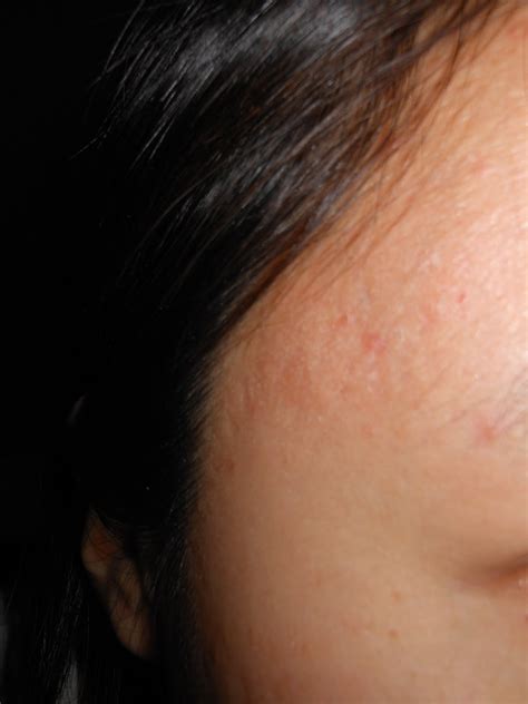 Acne Skin Care: Acne scar before and after retin-A (Tretinoin) treatment