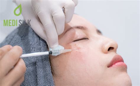 Dermal Fillers for Acne Scars: The Ultimate Guide • Medisilk