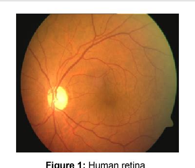 Figure 1 from Identification of Diabetic Maculopathy Stages using Fundus Images | Semantic Scholar