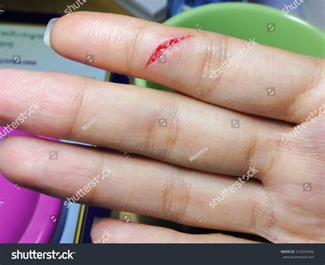 Finger Cut By Knife