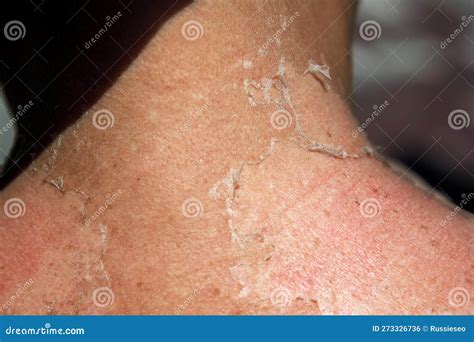 Peeling skin on the neck stock photo. Image of hurt - 273326736