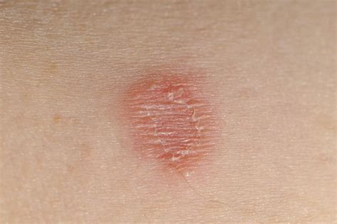 What Are The Different Types Of Viral Infection Rash - vrogue.co
