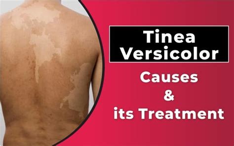 Tinea Versicolor Causes & its Treatment - Sakhiya Skin Clinic