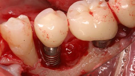 Dental implant contamination: 3 reasons behind a late-stage failure | Perio-Implant Advisory