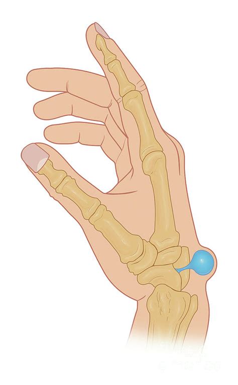 Ganglion Cyst On Hand