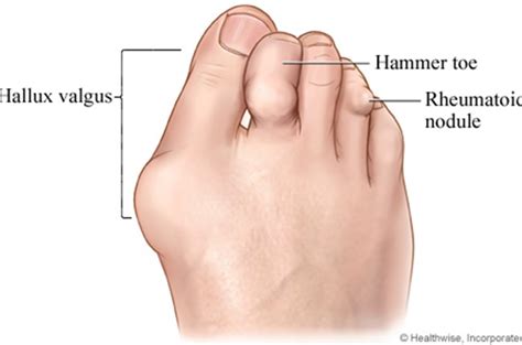 Rheumatoid Arthritis | Firefly Foot & Ankle Clinics