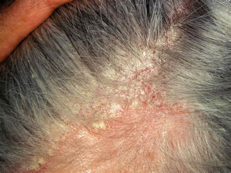 Seborrheic Dermatitis: Symptoms, Treatment, Photos, & More