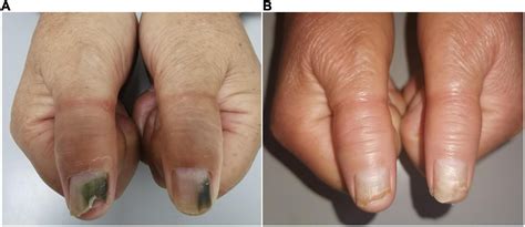 Frontiers | Case report: Novel use of the conventional method- chemical nail avulsion may be ...