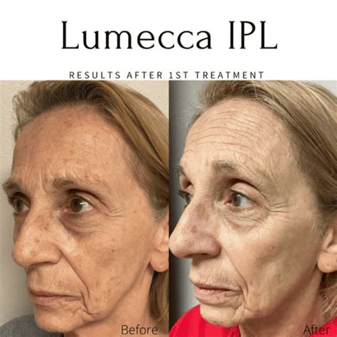 Lumecca IPL Before & After Images | EMME Skin Studio