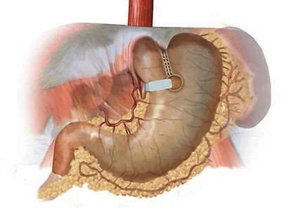 Gastroplasty Procedure in Borivali West , Mumbai , We Care Health Services | ID: 14864402930