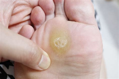 What’s the Difference Between Foot Corns vs Foot Calluses? - Foot and Ankle Group