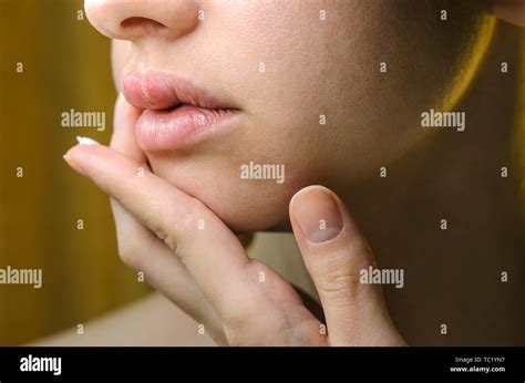 Woman Applying Ointment on Her Upper Lip with Herpes. Medical ...