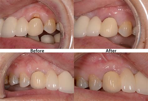 Receding Gum Lift Procedure - Ohio Cosmetic Dentists Columbus Ohio