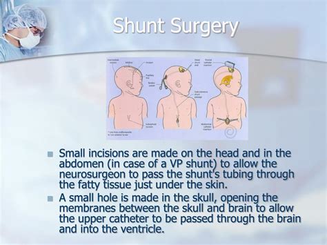 PPT - Hydrocephalus & Shunts PowerPoint Presentation - ID:431868