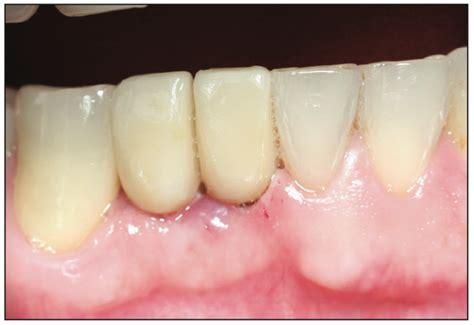 Ceramic Implants and Dental Implant Rehabilitation, Part I - Dentistry ...