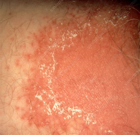 Cutaneous Candidiasis Causes, Symptoms, Diagnosis Treatment, 59% OFF