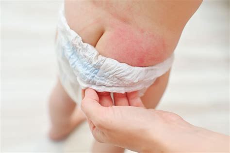 The Best Way to Get Rid of Baby Diaper Rash - Flash Uganda Media