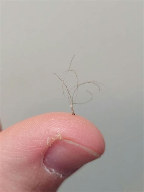 Pili Multigemini - multiple hairs growing from the same follicle : r/mildlyinteresting