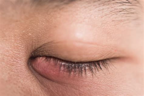 Blocked Tear Duct - Symptoms, Causes, and Treatment - Diamond Vision