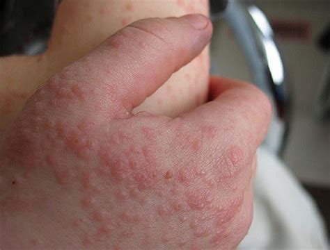 Mononucleosis Amoxicillin Rash / Infectious mononucleosis | DermNet NZ - Risk of rash with some ...