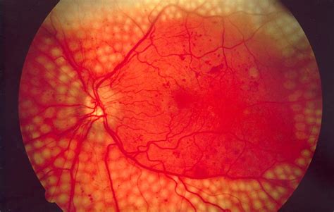 Diabetic retinopathy - Wikipedia