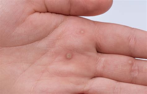 Warts | NY | Hudson Dermatology