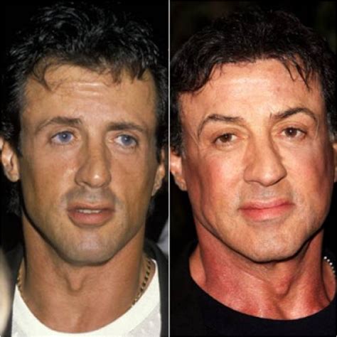 10+ Sylvester Stallone Hair Transplant - UmarKounain