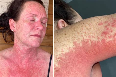 Mum left in agony with a burning rash due to ‘severe reaction to Covid vaccine two weeks after ...