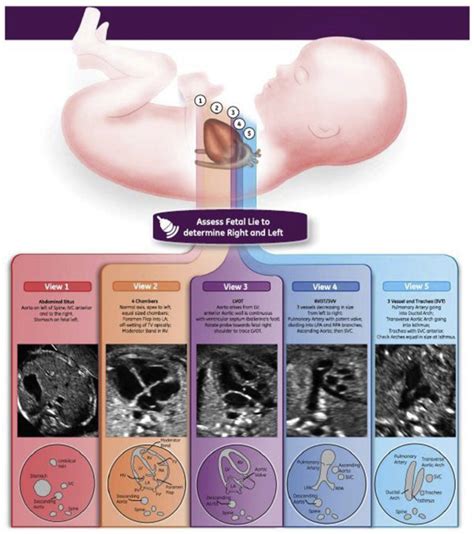 Advances in fetal echocardiography - Seminars in Fetal and Neonatal Medicine