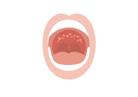 Normal Roof Of Mouth Pictures, Lesions On The Roof Of The Mouth Photo Quiz American Family ...